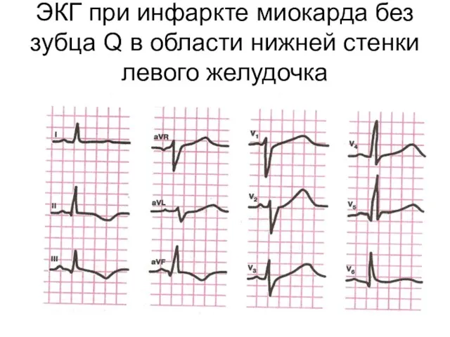 ЭКГ при инфаркте миокарда без зубца Q в области нижней стенки левого желудочка