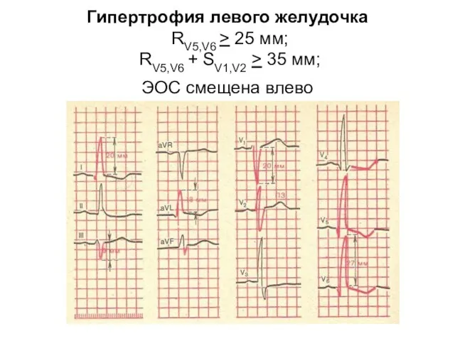 Гипертрофия левого желудочка RV5,V6 > 25 мм; RV5,V6 + SV1,V2 > 35 мм; ЭОС смещена влево