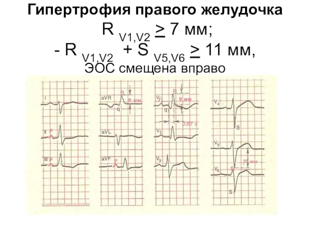 Гипертрофия правого желудочка R V1,V2 > 7 мм; - R V1,V2