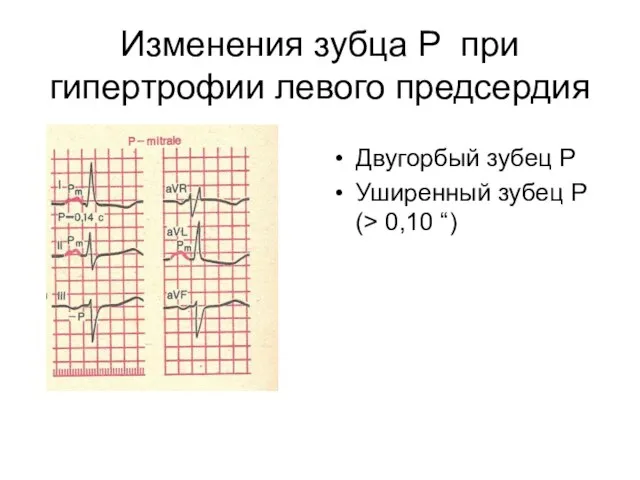 Изменения зубца P при гипертрофии левого предсердия Двугорбый зубец Р Уширенный зубец Р (> 0,10 “)