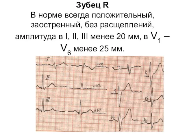 Зубец R В норме всегда положительный, заостренный, без расщеплений, амплитуда в