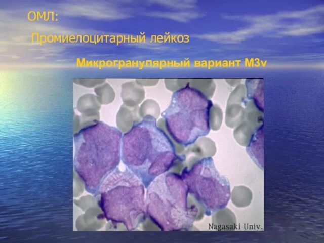 ОМЛ: Промиелоцитарный лейкоз Микрогранулярный вариант М3v