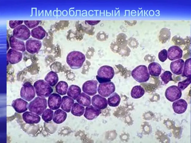 Лимфобластный лейкоз