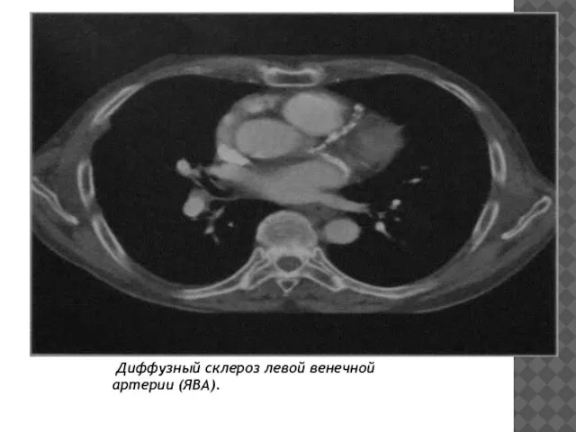 Диффузный склероз левой венечной арте­рии (ЯВА).