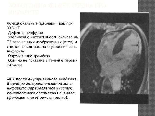 ЭФФЕКТИВНА ЛИ МРТ СЕРДЦА ПРИ ИНФАРКТЕ Функциональные признаки - как при