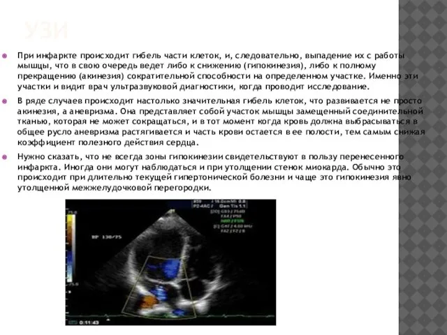 УЗИ При инфаркте происходит гибель части клеток, и, следовательно, выпадение их