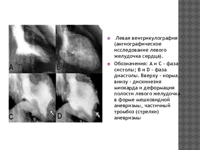 Левая вентрикулография (ангиографическое исследование левого желудочка сердца). Обозначения: А и С