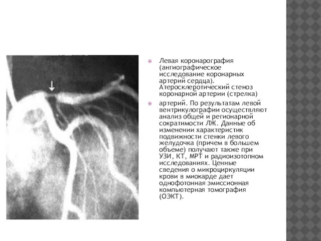 Левая коронарография (ангиографическое исследование коронарных артерий сердца). Атеросклеротический стеноз коронарной артерии