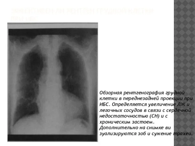 ЭФФЕКТИВЕН ЛИ РЕНТГЕН ГРУДНОЙ КЛЕТКИ ПРИ ИБС Обзорная рентгено­графия грудной клетки