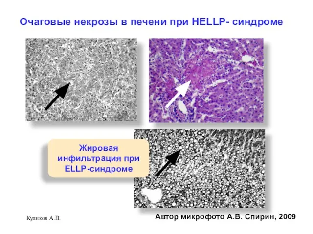 Куликов А.В. Очаговые некрозы в печени при HELLP- синдроме Автор микрофото