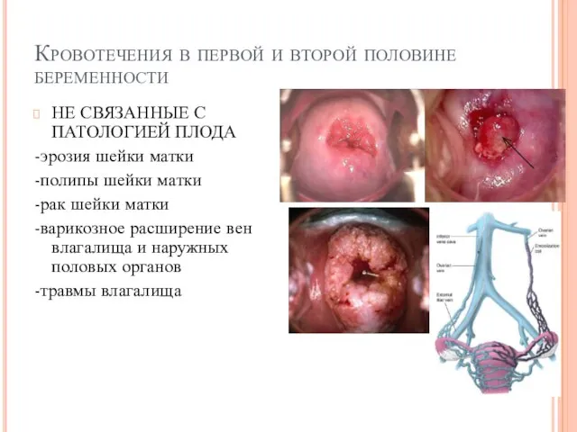 Кровотечения в первой и второй половине беременности НЕ СВЯЗАННЫЕ С ПАТОЛОГИЕЙ