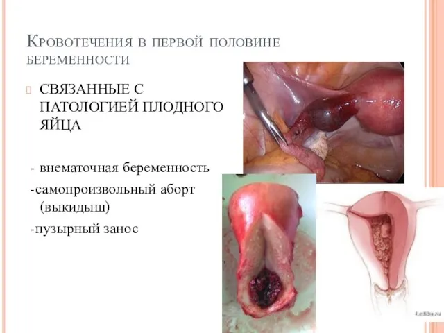 Кровотечения в первой половине беременности СВЯЗАННЫЕ С ПАТОЛОГИЕЙ ПЛОДНОГО ЯЙЦА -