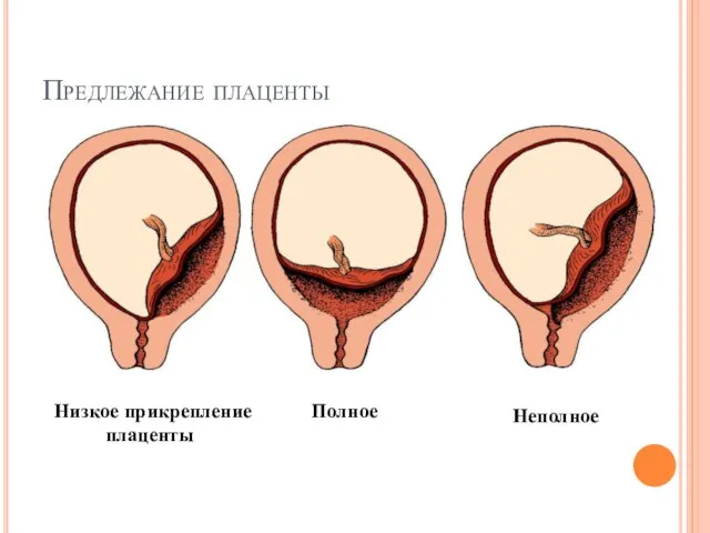 Предлежание плаценты Полное Неполное Низкое прикрепление плаценты