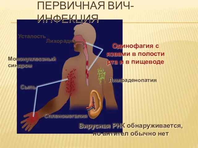 ПЕРВИЧНАЯ ВИЧ-ИНФЕКЦИЯ Мононуклеозный синдром Одинофагия с язвами в полости рта и