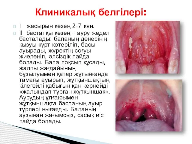 І жасырын кезең 2-7 күн. ІІ бастапқы кезең – ауру жедел