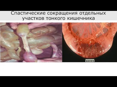 Спастические сокращения отдельных участков тонкого кишечника