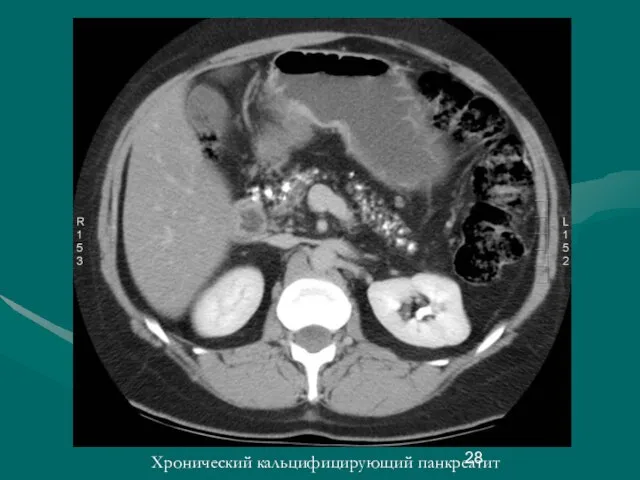 Хронический кальцифицирующий панкреатит