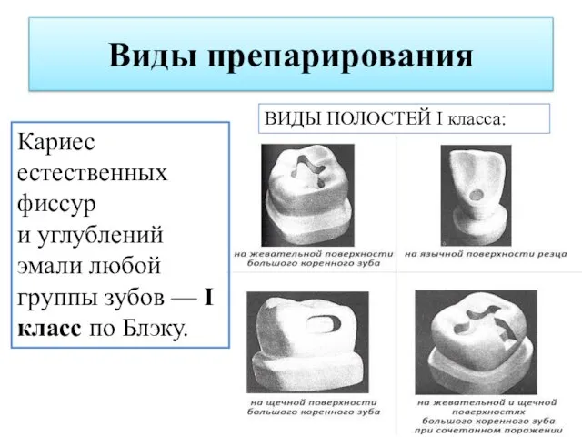 Виды препарирования Кариес естественных фиссур и углублений эмали любой группы зубов