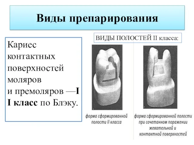 Виды препарирования Кариес контактных поверхностей моляров и премоляров —II класс по Блэку. ВИДЫ ПОЛОСТЕЙ II класса: