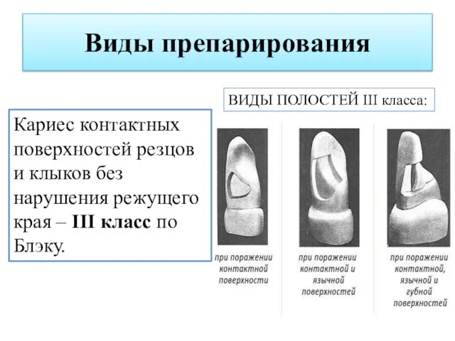 Виды препарирования ВИДЫ ПОЛОСТЕЙ III класса: Кариес контактных поверхностей резцов и