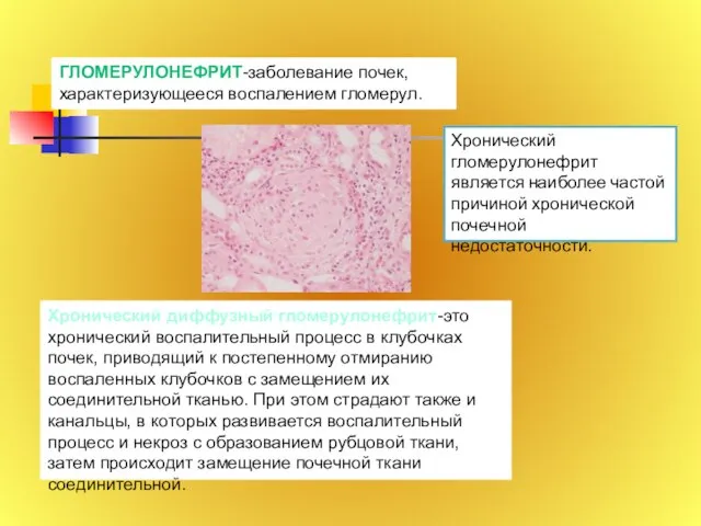 ГЛОМЕРУЛОНЕФРИТ-заболевание почек, характеризующееся воспалением гломерул. Хронический диффузный гломерулонефрит-это хронический воспалительный процесс