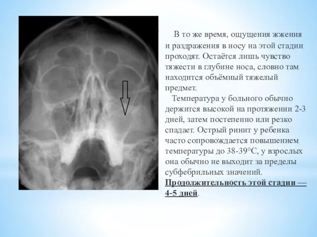 В то же время, ощущения жжения и раздражения в носу на