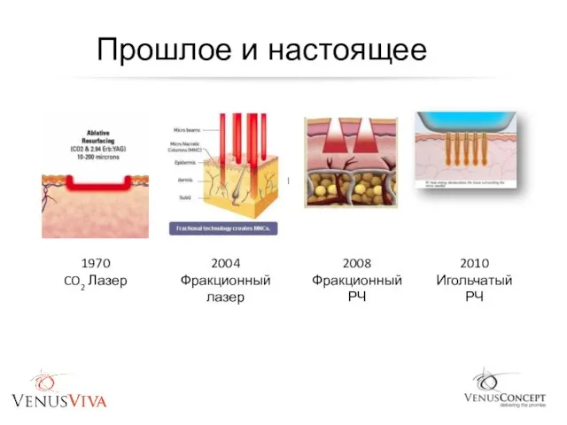 Прошлое и настоящее 1970 CO2 Лазер 2004 Фракционный лазер 2008 Фракционный РЧ 2010 Игольчатый РЧ