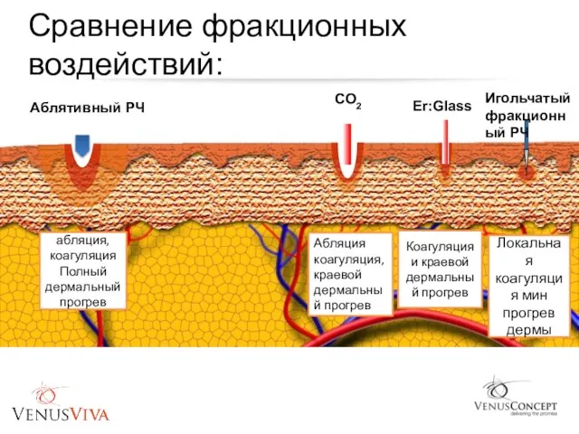 Сравнение фракционных воздействий: Аблятивный РЧ CO2 Er:Glass абляция, коагуляция Полный дермальный