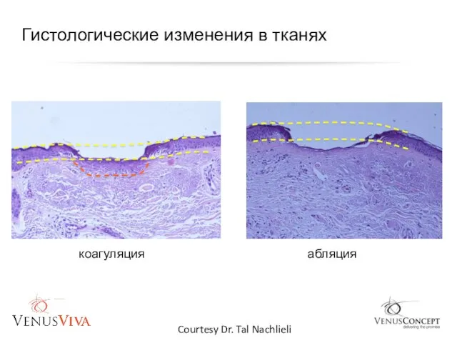 Courtesy Dr. Tal Nachlieli коагуляция абляция Гистологические изменения в тканях