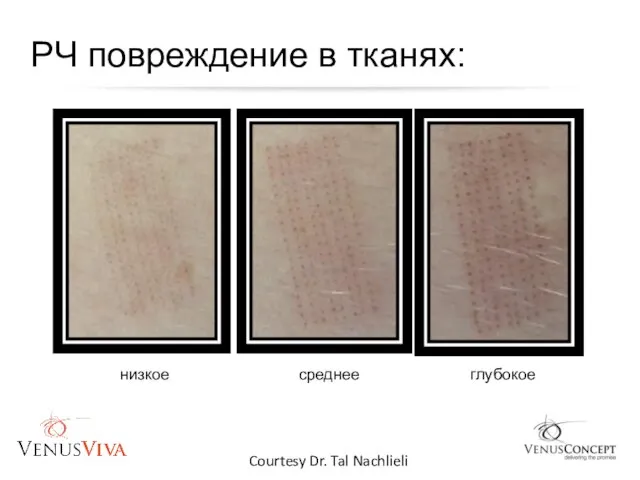 Courtesy Dr. Tal Nachlieli РЧ повреждение в тканях: низкое среднее глубокое