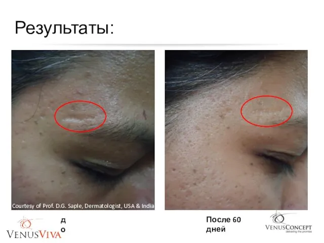 Результаты: Courtesy of Prof. D.G. Saple, Dermatologist, USA & India до После 60 дней