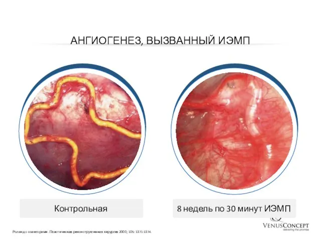 АНГИОГЕНЕЗ, ВЫЗВАННЫЙ ИЭМП Roland et al. Plast Reconstr Surg 2000;105:1371–1374 Контрольная