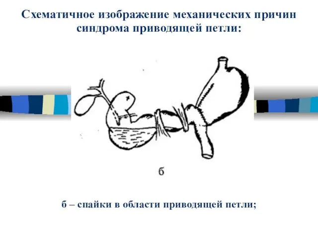 Схематичное изображение механических причин синдрома приводящей петли: б – спайки в области приводящей петли;