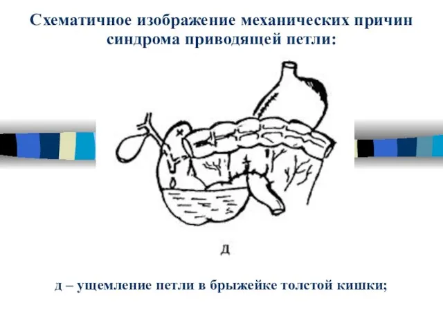 Схематичное изображение механических причин синдрома приводящей петли: д – ущемление петли в брыжейке толстой кишки;