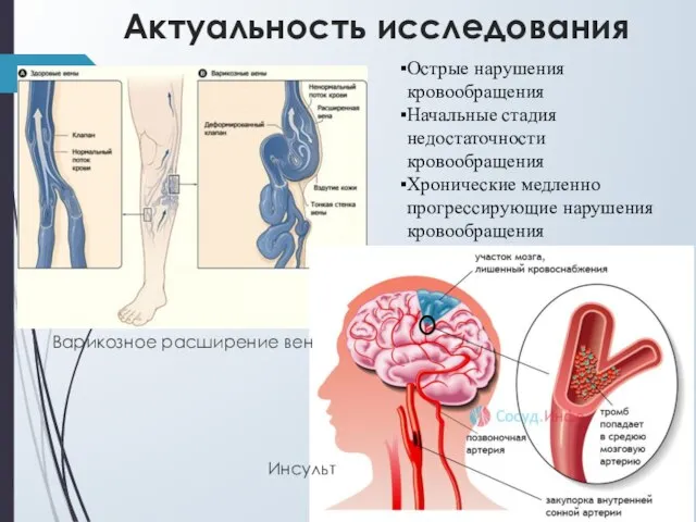 Актуальность исследования Инсульт Острые нарушения кровообращения Начальные стадия недостаточности кровообращения Хронические