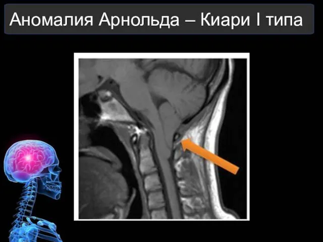 Аномалия Арнольда – Киари I типа