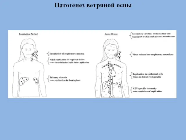 Патогенез ветряной оспы