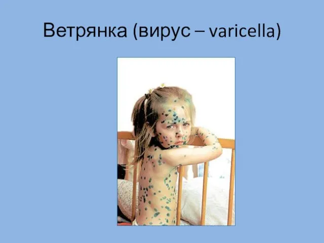 Ветрянка (вирус – varicella)