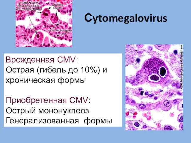 Сytomegalovirus Врожденная CMV: Острая (гибель до 10%) и хроническая формы Приобретенная CMV: Острый мононуклеоз Генерализованная формы