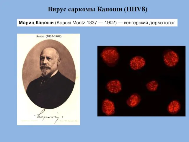 Вирус саркомы Капоши (HHV8) Мориц Капоши (Kaposi Moritz 1837 — 1902) — венгерский дерматолог