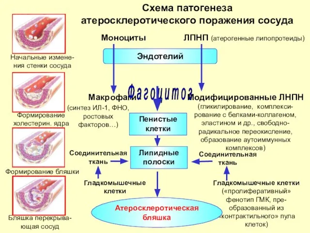 Схема патогенеза атеросклеротического поражения сосуда Эндотелий Моноциты ЛПНП (атерогенные липопротеиды) Макрофаги