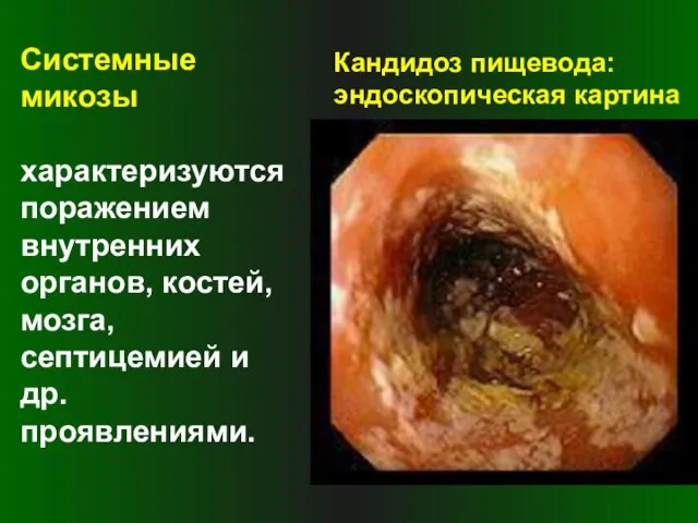 Системные микозы характеризуются поражением внутренних органов, костей, мозга, септицемией и др. проявлениями. Кандидоз пищевода: эндоскопическая картина