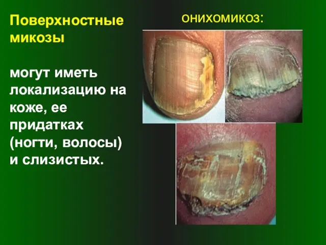 Поверхностные микозы могут иметь локализацию на коже, ее придатках (ногти, волосы) и слизистых. онихомикоз: