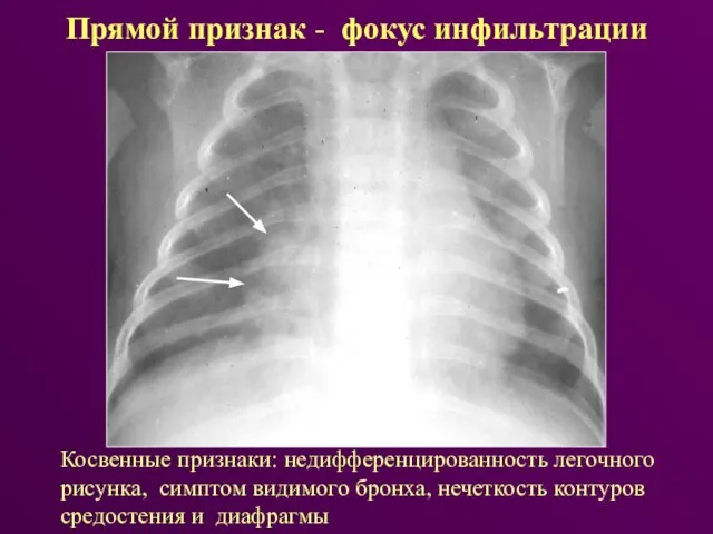 Прямой признак - фокус инфильтрации Косвенные признаки: недифференцированность легочного рисунка, симптом