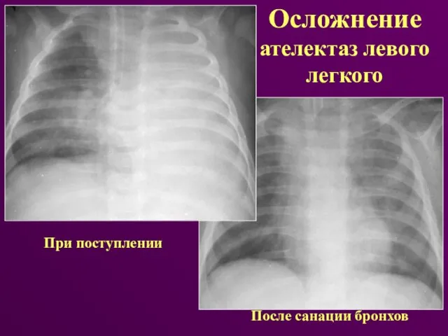 Осложнение ателектаз левого легкого При поступлении После санации бронхов