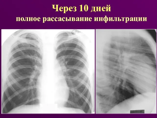 Через 10 дней полное рассасывание инфильтрации