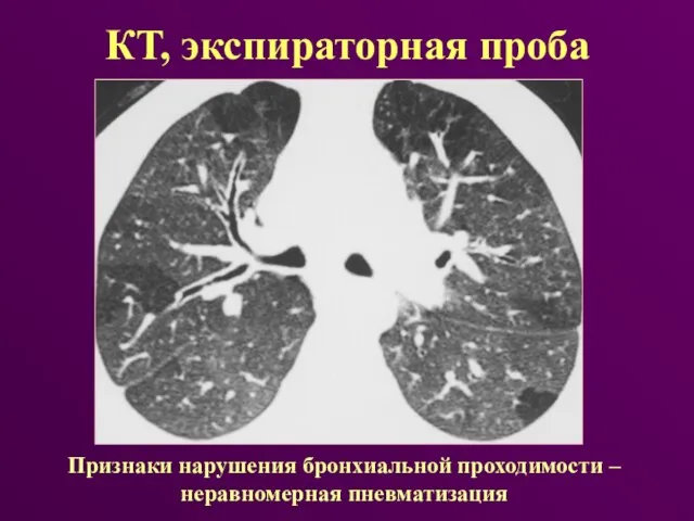 КТ, экспираторная проба Признаки нарушения бронхиальной проходимости – неравномерная пневматизация