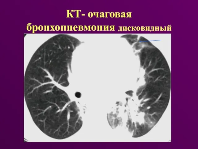 КТ- очаговая бронхопневмония дисковидный коллапс