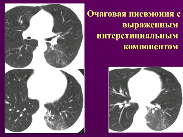 Очаговая пневмония с выраженным интерстициальным компонентом