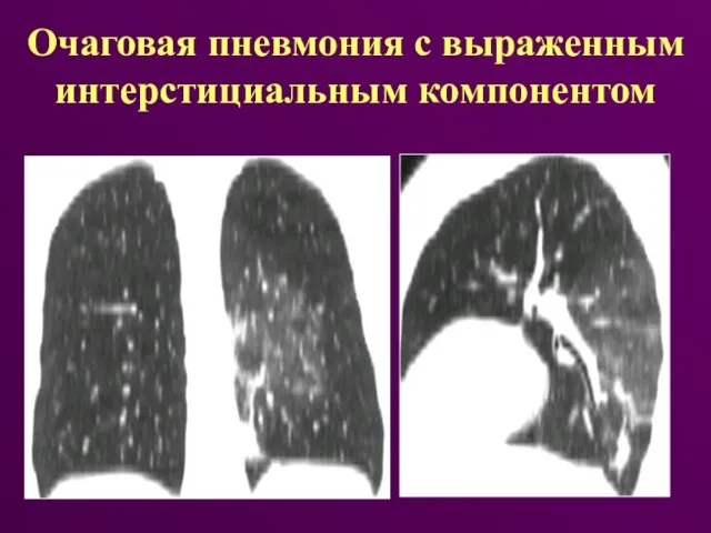 Очаговая пневмония с выраженным интерстициальным компонентом